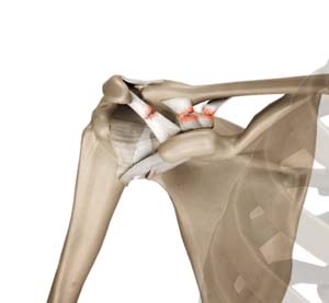 Acromioclavicular Joint Dislocation Treatment Creve Coeur, MO