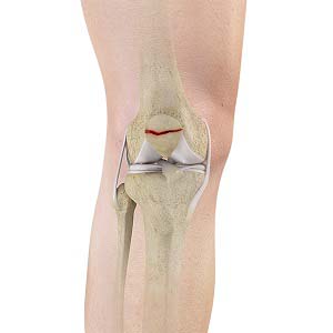 kneecap fracture